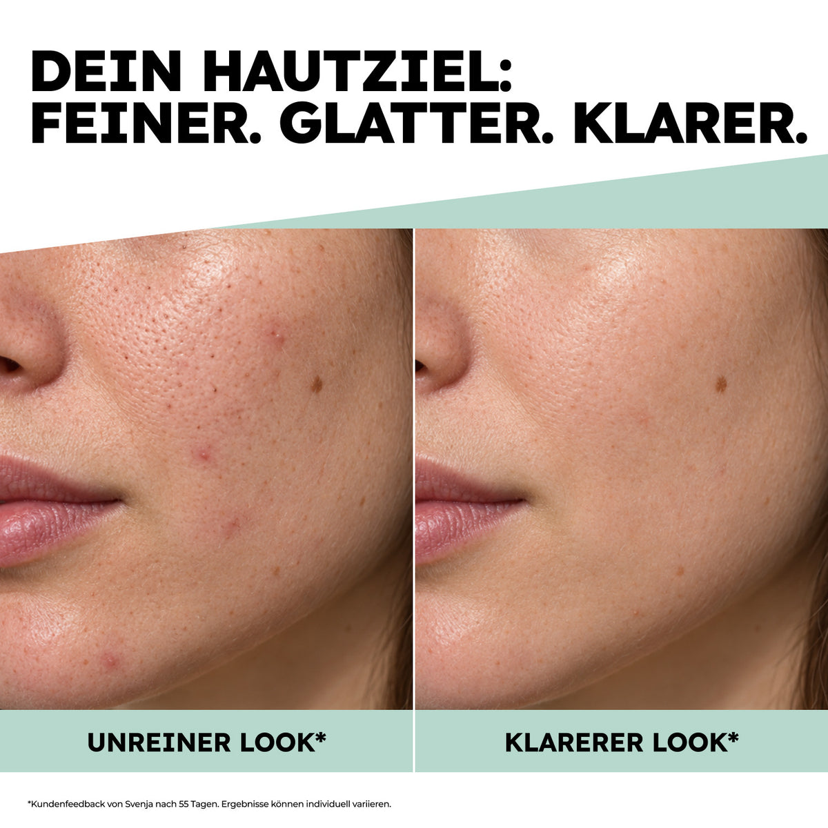BHA-Peeling: Vergleich eines unreineren und klareren Hautbilds; Kundenfeedback nach 55 Tagen, Ergebnisse können individuell variieren