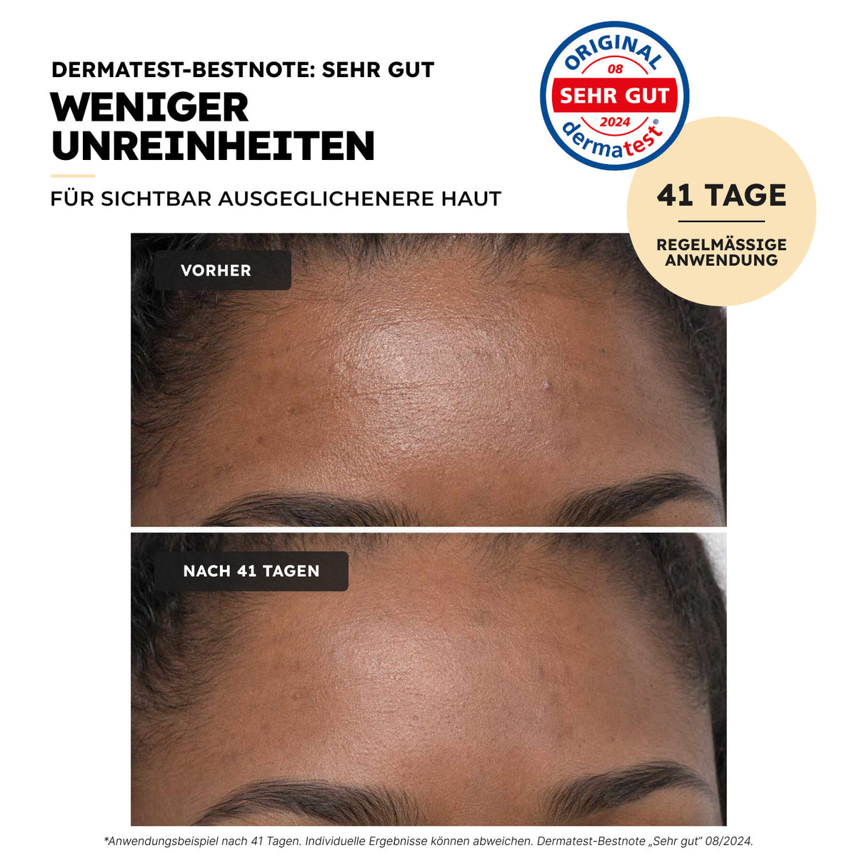 Niacinamid Serum – weniger Unreinheiten, Anwendungsbeispiel nach 41 Tagen